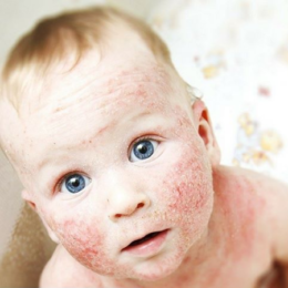 Атопічний дерматит у дитини - фото 1
