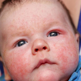 Атопічний дерматит у дитини - фото 2