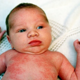 Атопічний дерматит у дитини - фото 3
