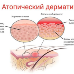 Атопічний дерматит у дитини - інфографіка