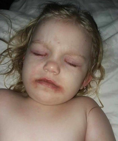 аллергия на детскую косметику